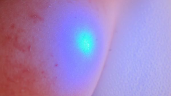 Les bienfaits de la photobiomodulation pour les douleurs et la cicatrisation